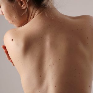 Back Skin Care Treatment